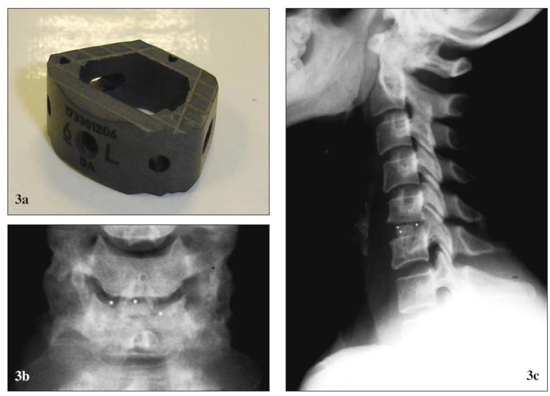 Karbónová náhrada medzistavcovej platničky Brantigan® (De PuySpine). (a) pred implantáciou, (b) po implantácii, RTG (b1) predná a (b2) bočná projekcia