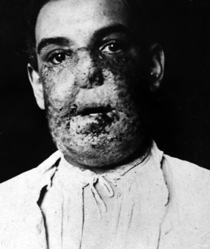 Lupus vulgaris – veliký medicínský problém své doby – vlastní archiv A. Trýba.