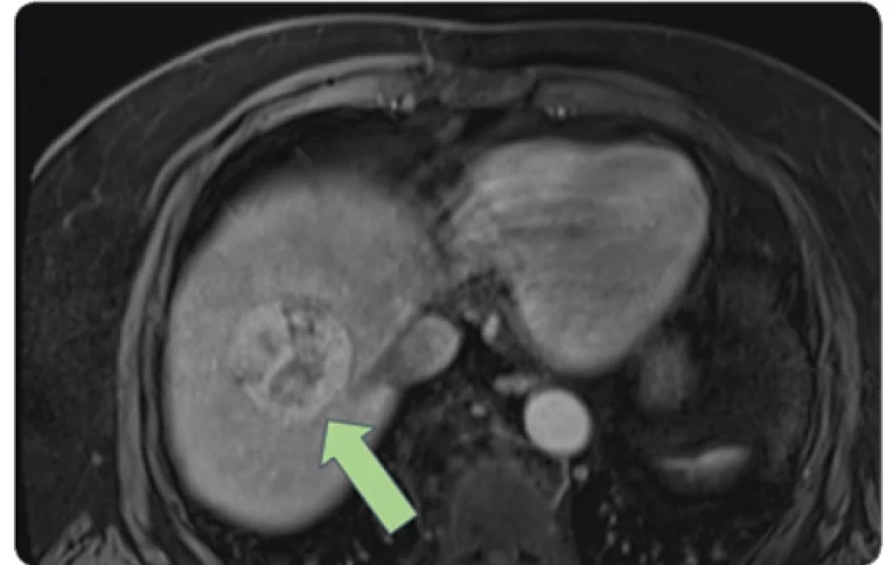  Initial MRI revealing an incidental solitary 5 cm liver lesion (green arrow) in segment VIII. 
