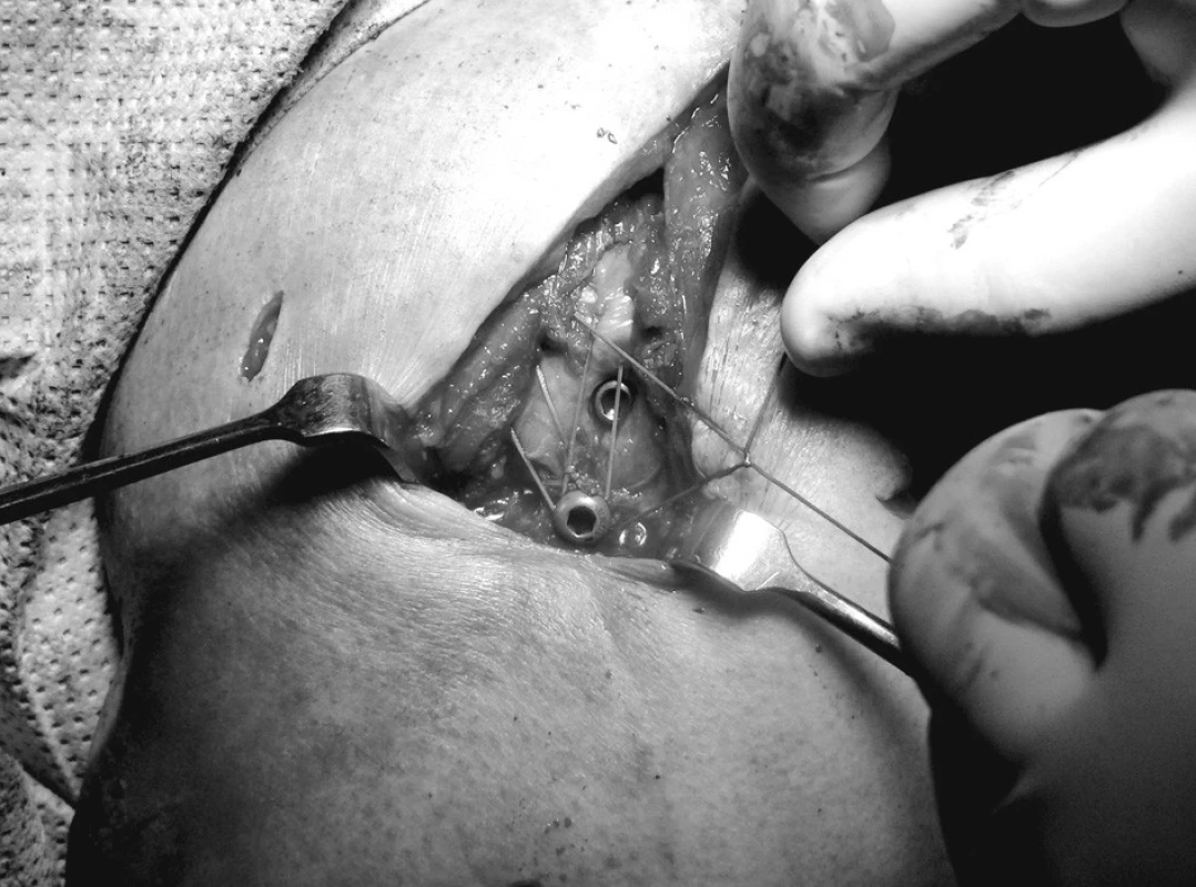 Fixace hrbolků pomocnými stehy k distálními laterálnímu šroubu, proximální šroub je již zanořen
Pic. 2. Fixation of the tuberi to the distal lateral screw with secondary stitching, the proximal screw is already immersed