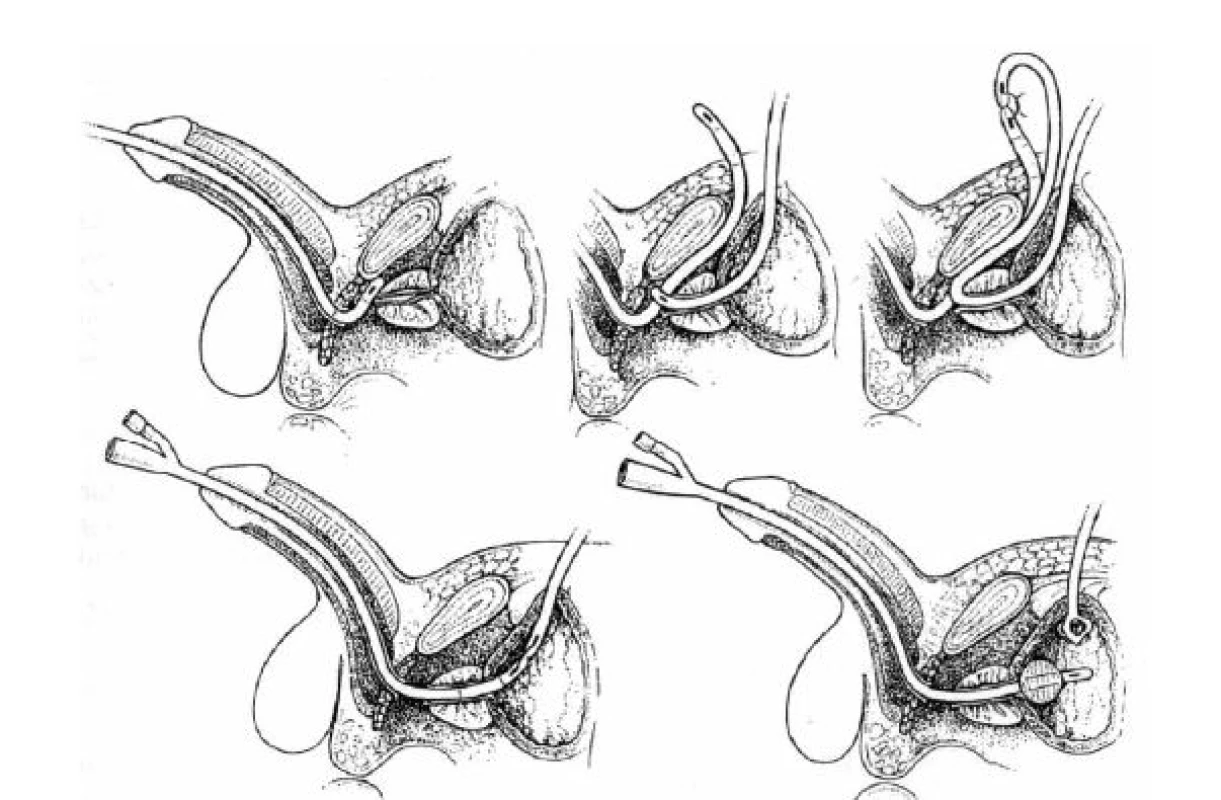 Realignment uretry
Fig. 2. Urethral realignment