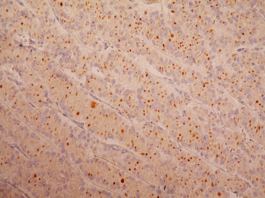 Imunohistochemie – pozitivní synapatofyzin
Fig. 3. Immunohistochemistry – positive synaptophysine labelling 