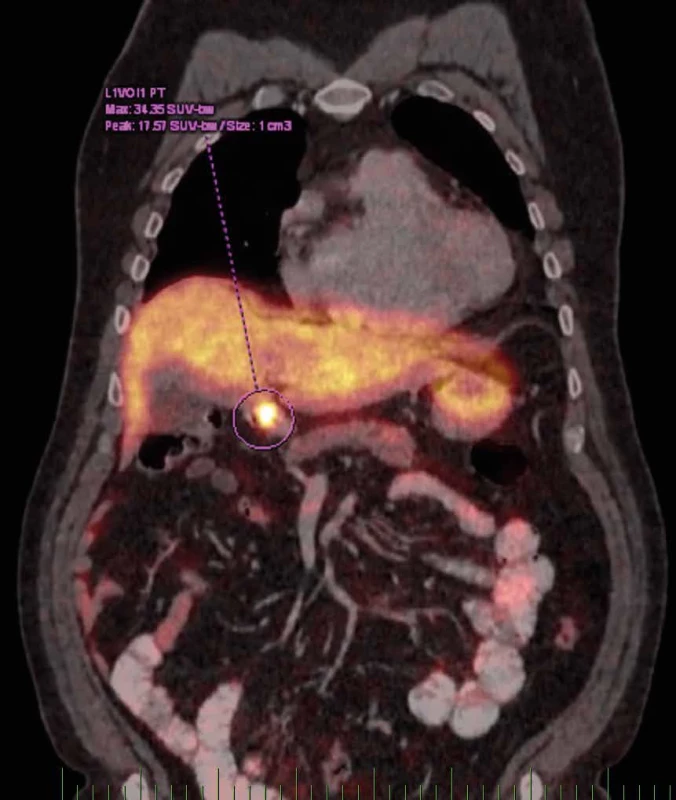 DOTATOC/PET s ložiskem v podjaterní krajině Fig. 7: DOTATOC/PET with the subhepatic lesion