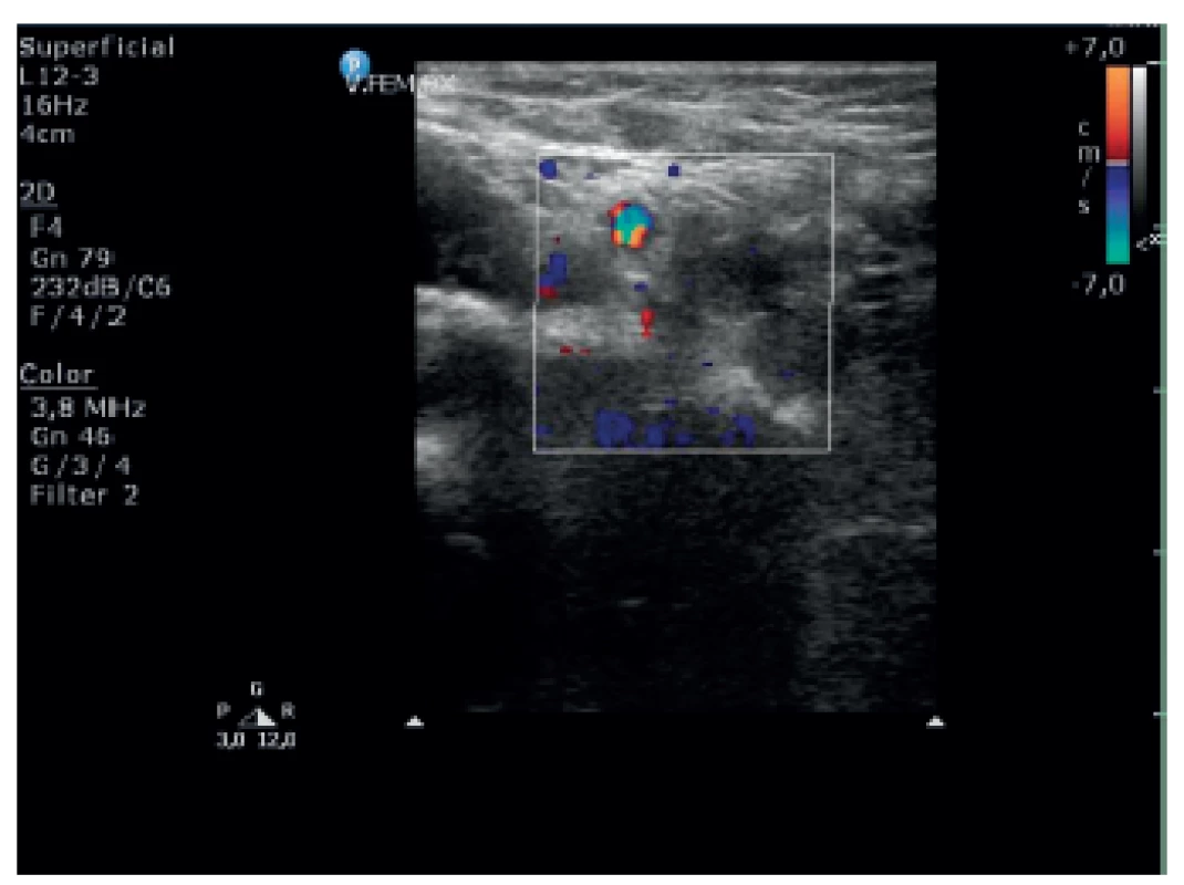 Trombus zmiešanej echogenity v oblasti femorálneho bulbu vpravo.
Fig. 2. Thrombus with mixed echogenicity in the area of right femoral bulb.