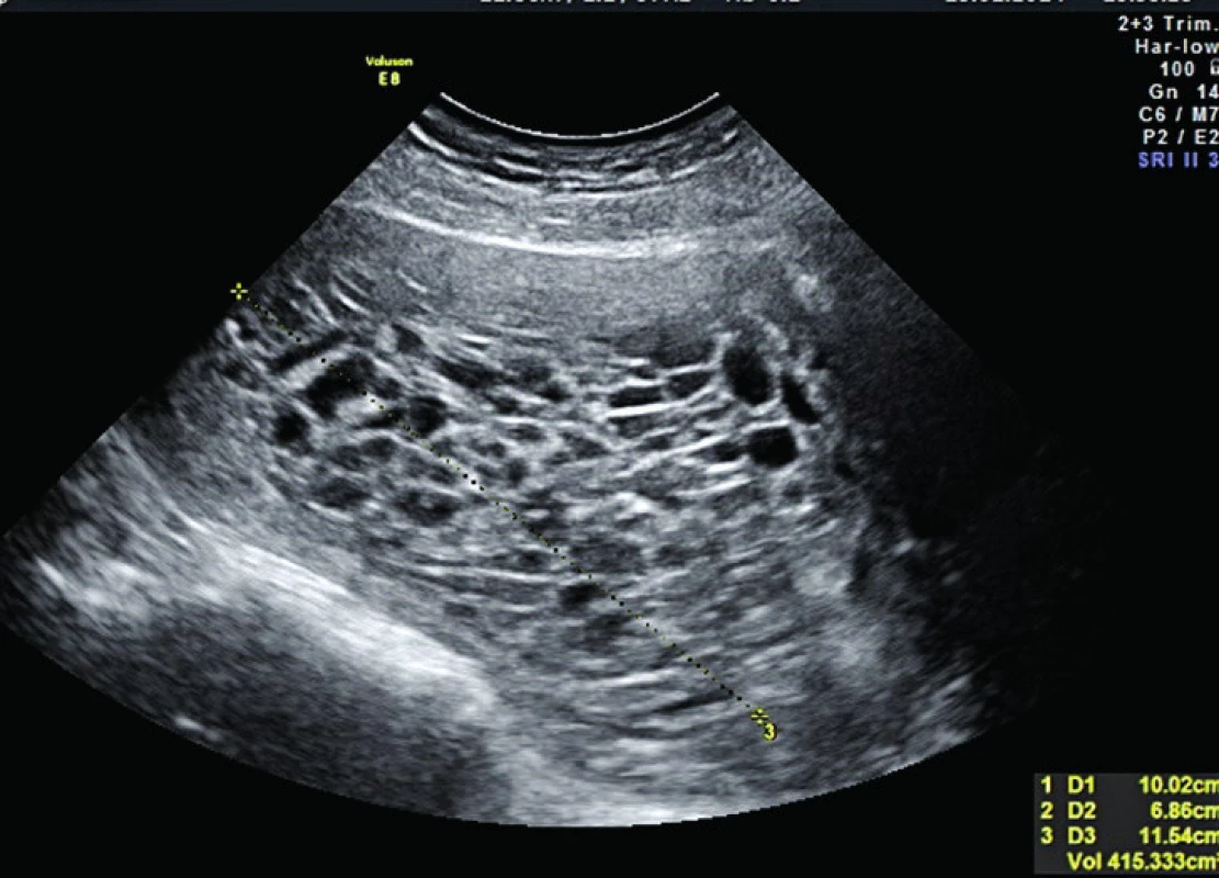 Mola hydatidosa completa. UZ transabdominální sagitální pohled, 15. týden těhotenství. Obsah dutiny děložní o rozměrech 10,02 × 6,86 × 11,54 cm, objemově 415,333 ccm vyplněn edematózními choriovými klky, plod chybí. Prakticky encyklopedický obraz vyzrálé formy kompletní moly v II. trimestru těhotenství v dobrém zvětšení na kvalitním UZ obrazu, kde již místo přirovnání k „snowstorm“ lze dobře detekovat jednotlivé edematózní hydatidy.