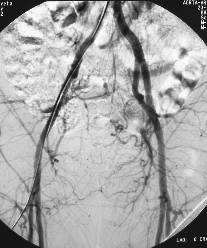 Pacient č. 2. Kontrolné angiografické vyšetrenie 3 mesiace po operácii
Pic. 5. Patient Nr. 2: Control angiography 3 months following the procedure