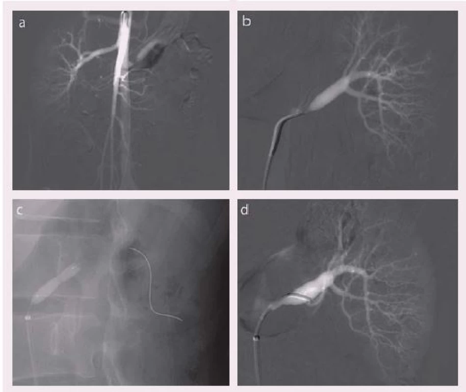 Unifokální fibromuskulární dysplazie u 19leté dívky: a) digitální substrakční angiografie – levá a. renalis v proximálním segmentu s významnou stenózou, b) selektivní angiografie levé a. renalis – významná stenóza, c) perkutánní transluminální angioplastika, d) kontrolní angiografie po dilataci s příznivým nálezem. Převzato z [10].