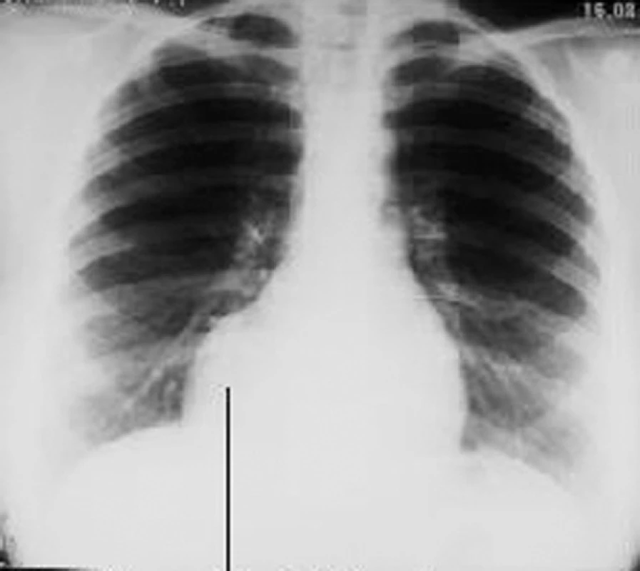 RTG parakardiální cysty vpravo
Fig. 9. An x- ray view of a paracardial cyst on the right