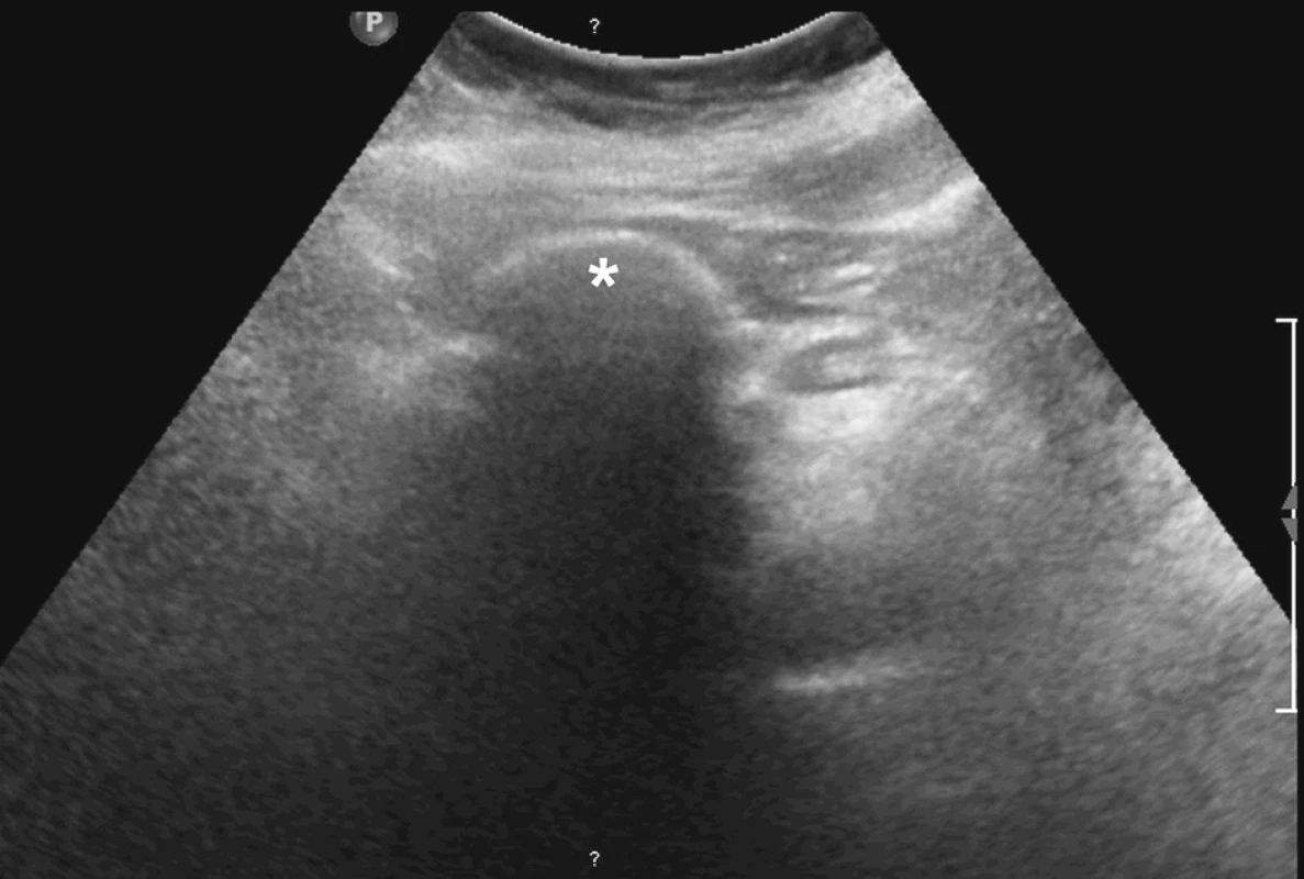 Ultrazvukové vyšetření pravého hypochondria – mediálně od jater zobrazuje výrazně odrazivý oválný útvar s kompletním akustickým stínem za ním – vycestovaný žlučový konkrement (*)
Fig. 2. Ultrasound of the right hypochondrium – medially to the liver, depicts a pronounced oval formation with a complete acustic shadow behind it – an excreted bile concrement (*)