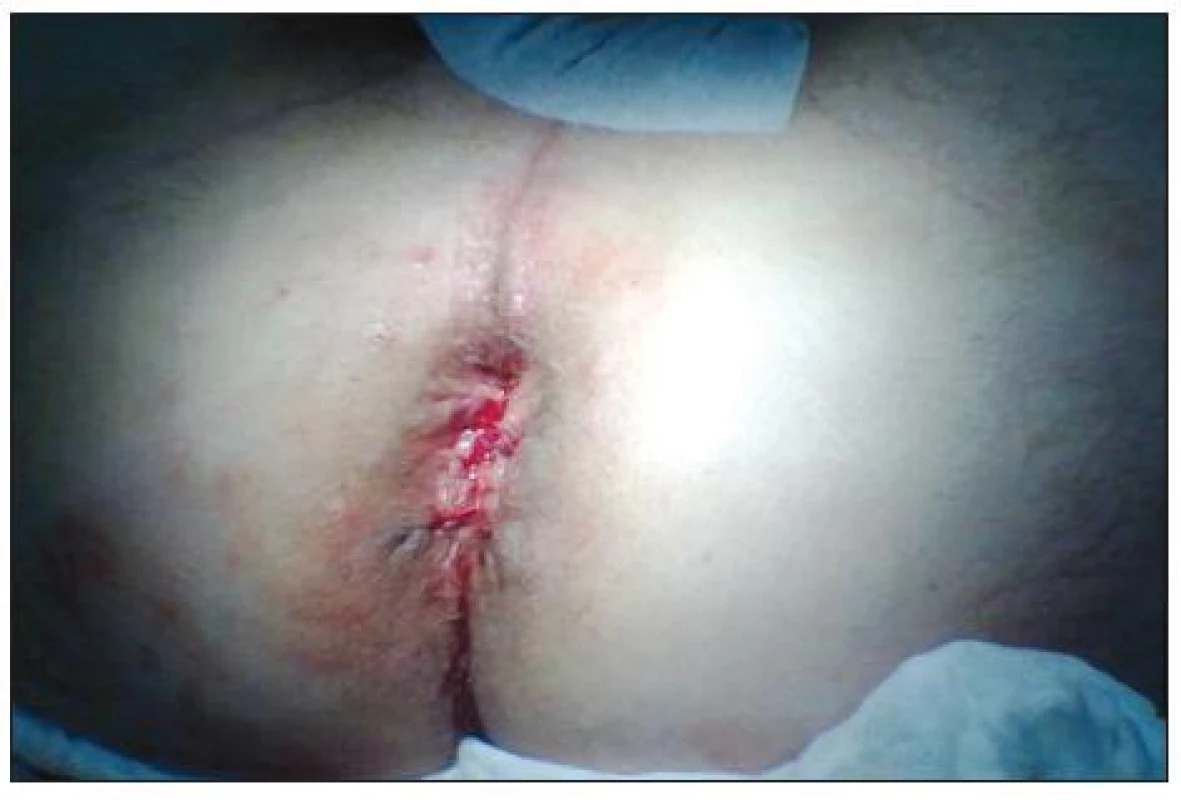 Stav anu den po výkonu
Fig. 3. Condition of anus one day after procedure