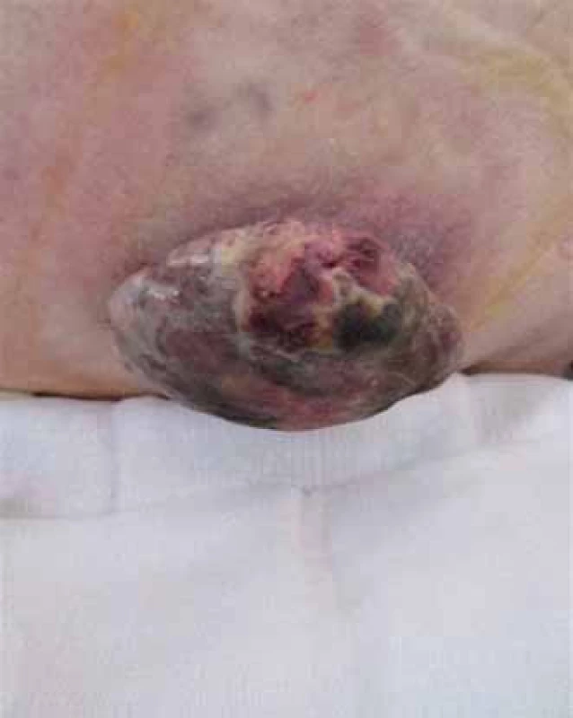 Exofyticky rastúci tumor chrbta.