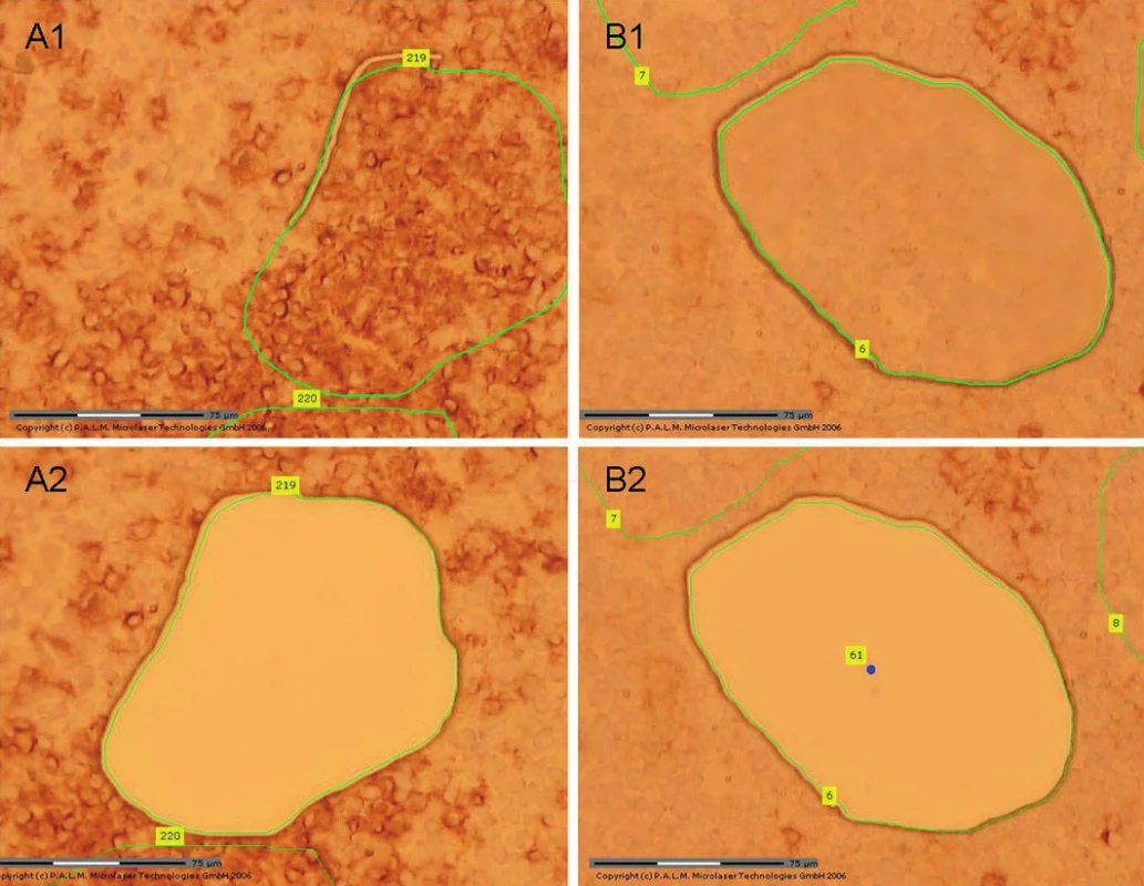 Pacient 7. Mikrodisekce ze zmrazených řezů, imunohistochemický průkaz exprese molekuly CD23. A1: Vybraná oblast pro mikrodisekci CD23 pozitivních buněk. A2: Stejná oblast po mikrodisekci. B1: Vybraná oblast pro mikrodisekci CD23 negativních buněk. B2: Stejná oblast po mikrodisekci.