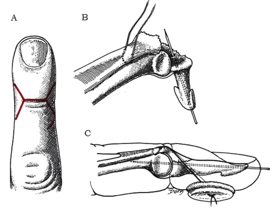 Otvorená metóda redukcie mallet deformity
a) dorzálna transverzálna incízia s prolongáciou tvaru V na okrajoch na dvihnutie 4 lalokov, b) naloženie Blalockovej sutúry, ktorá vytvára U tvar v hĺbke šľachy pri okraji avulzného fragmentu; zavedený obojstranne zaostrený Kirschnerov drôt anterográdne do distálneho článku
c) fragment je reponovaný, Kirschnerov drôt zavedený proximálne cez DIP, sutúra uviazaná cez gombík na konci procedúry zviera 45° uhol s DIP kĺbom [2].
Fig. 4: Open reduction of a mallet finger with fracture
a) dorsal transverse incision with V-shaped prolongation at the edges to allow four skin flaps to be raised,
b) providing Blalock suture, which makes an U-shape under the deep surface of the tendon at the edge of the avulsed fragment; a double-ended K-wire is drilled anterogradely into the distal phalanx,
c) reposition of the fragment, the K-wire is driven proximally through DIP joint, suture is tied through the button and makes a 45˚ angle with the DIP joint [2].