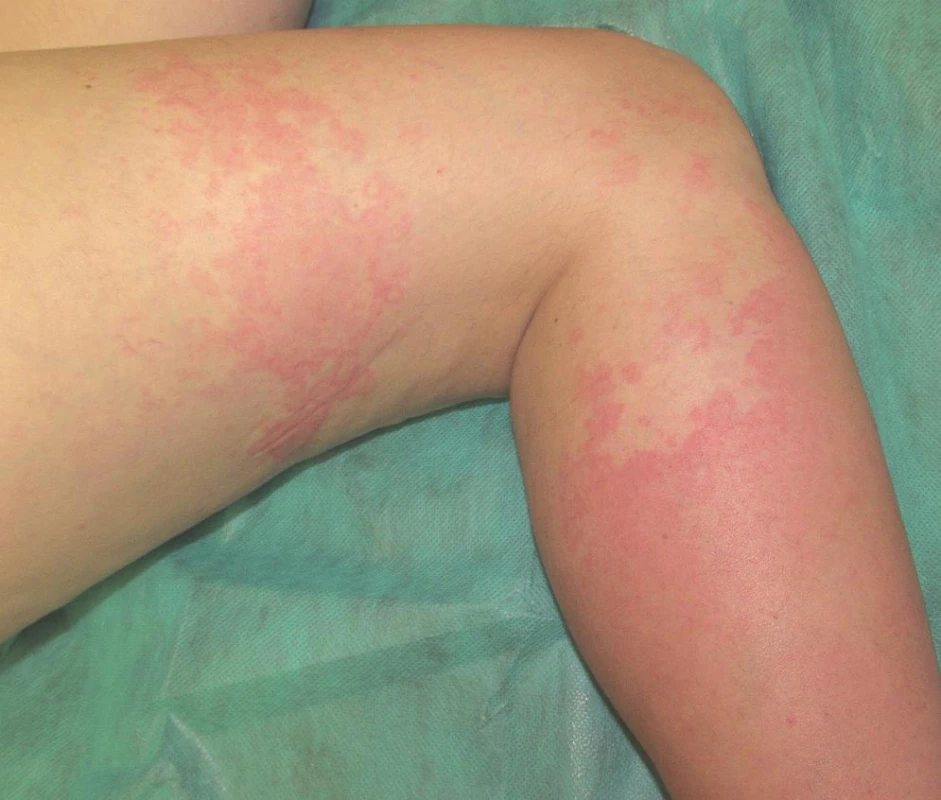 Fotoalergická kontaktní dermatitida na dolní končetině (ketoprofen).
