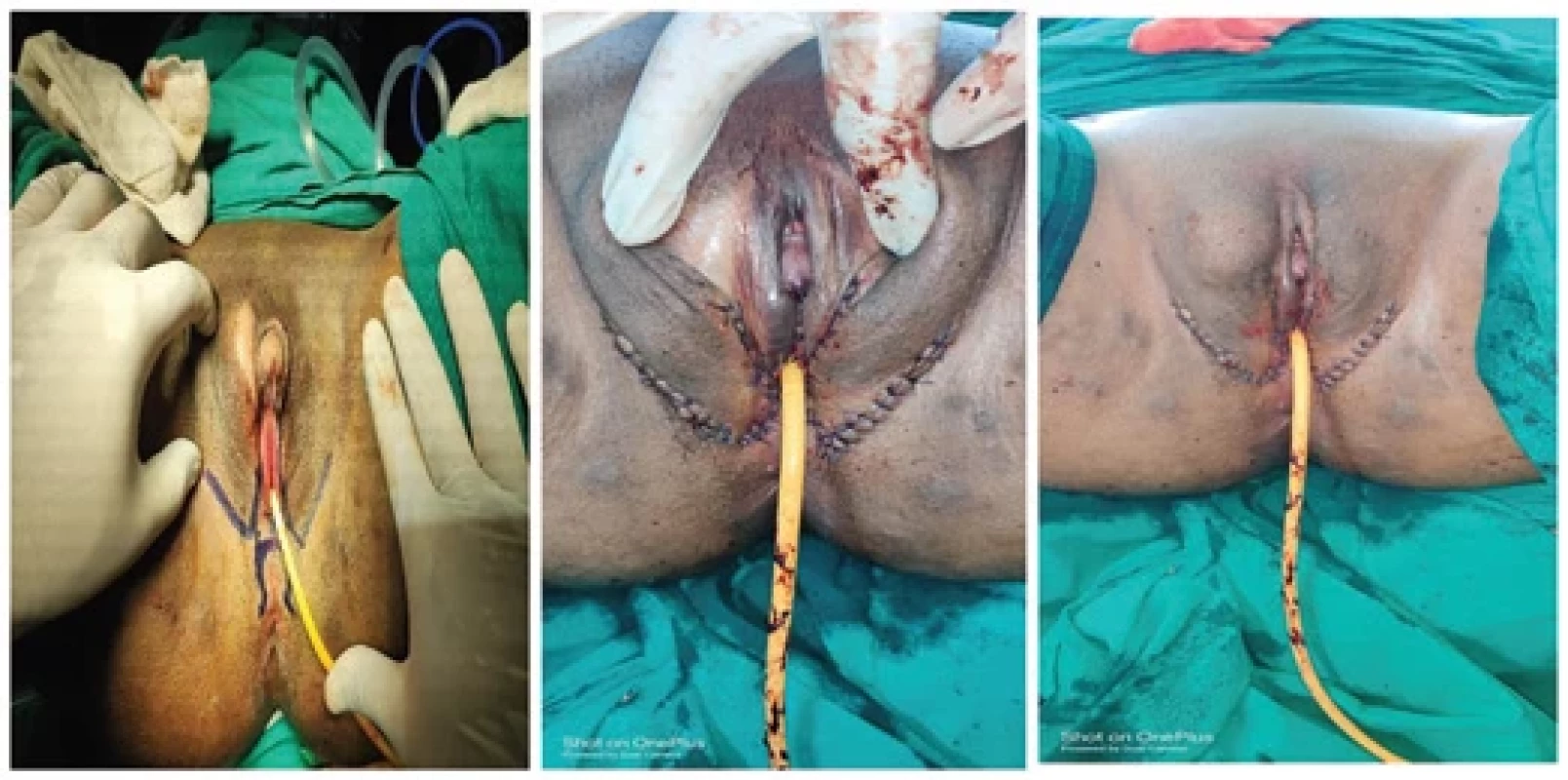 Preoperative and postoperative pictures of a case of androgen insensitivity syndrome with ambiguous genitalia.