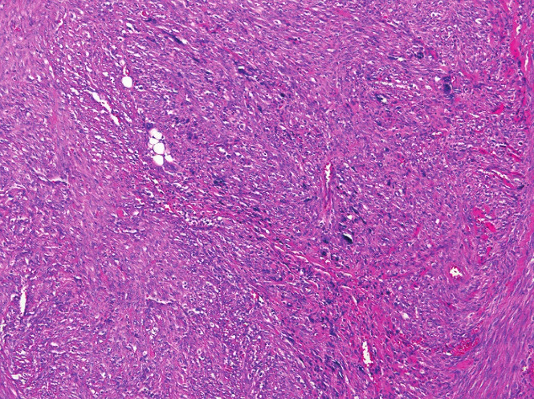 Leiomyosarkom s bizarními buňkami Hematoxylin-eosin, zvětšení 100x.
Fig. 2: Leiomyosarcoma with bizarre cells Hematoxylin-Eosin, 100x magnification.