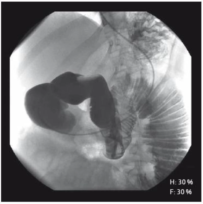 RtG-enteroklýza: distenze jejuna se zachovalým reliéfem, bez peristaltiky.
Fig. 1. Barium small bowel follow-through: dilatation of proximal jejunum with normal mucosa, but without intestinal activity.
