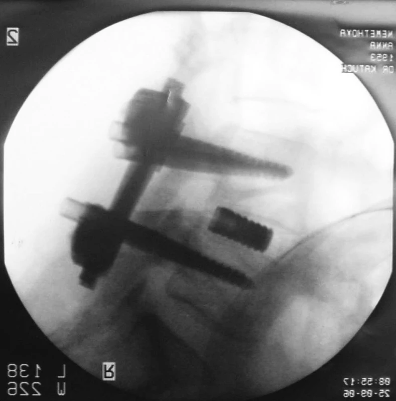 PLIF so zadnou transpedikulárnou stabilizáciou v jednej úrovni L4/L5, 360° fúzia, bočná projekcia (vlastný klinický materiál)
Fig. 1. PLIF with posterior transpedicular stabilisation in one level L4/L5, 360° fusion, lateral projection (authors’outcomes)