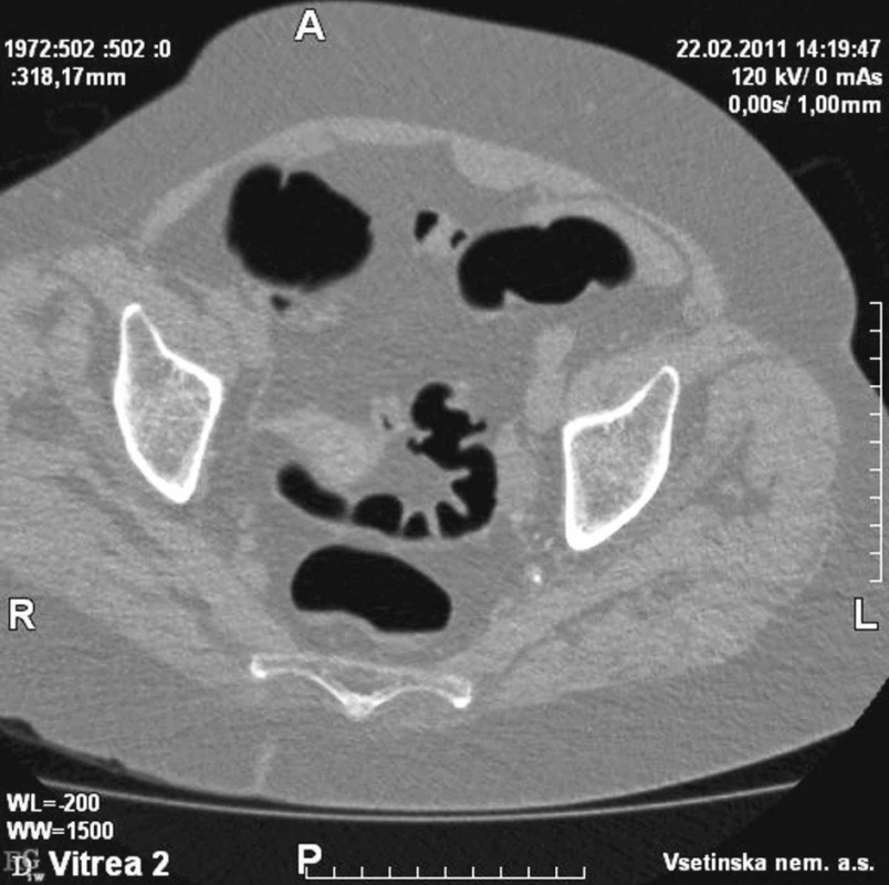 Divertikulóza CT
Fig. 1. Divertikulosis on CT