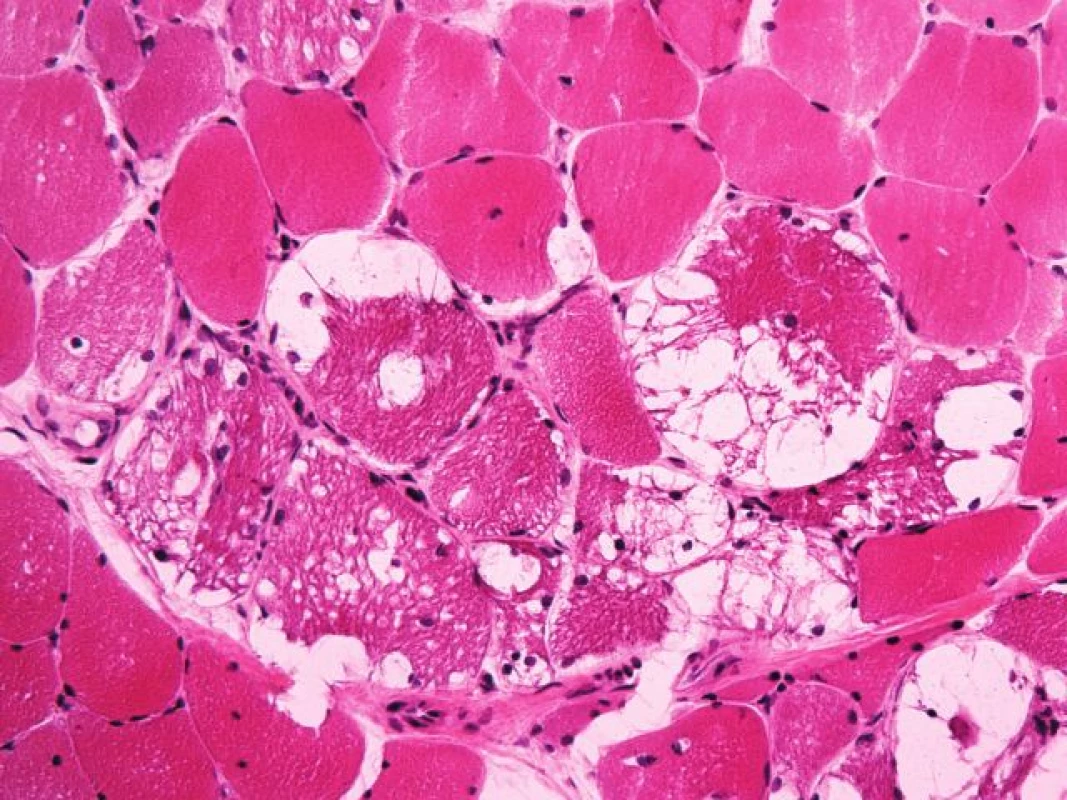 <i>Případ č. 5 – Pompeho nemoc léčená antimalariky</i>. Vakuolizace svalových vláken v barvení izopentanem zmraženého řezu barveném hematoxylinem-eozinem (zvětšení 200x).
