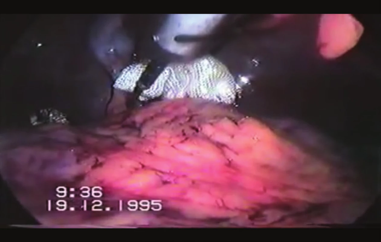 Komprese místa krvácení v podjaterní krajině
Fig. 2: Compression of the bleeding site in the subhepatic area