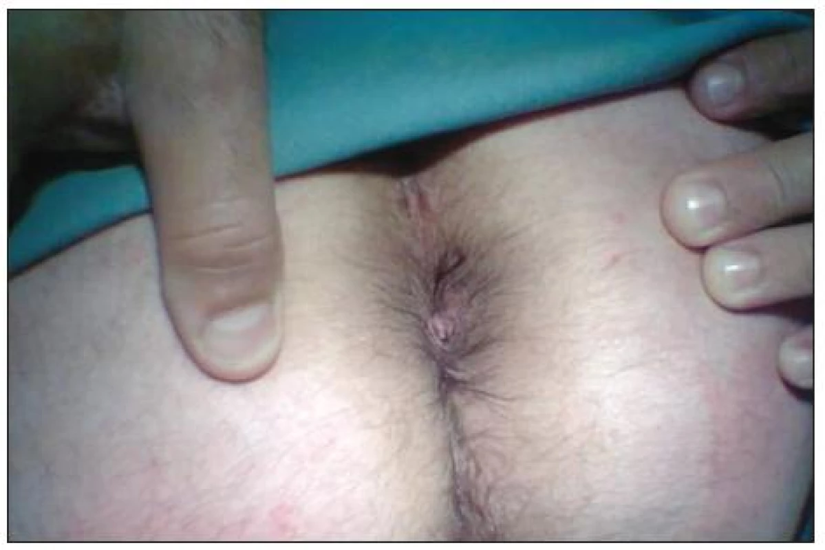Anus měsíc po operaci
Fig. 4. Result one month after procedure