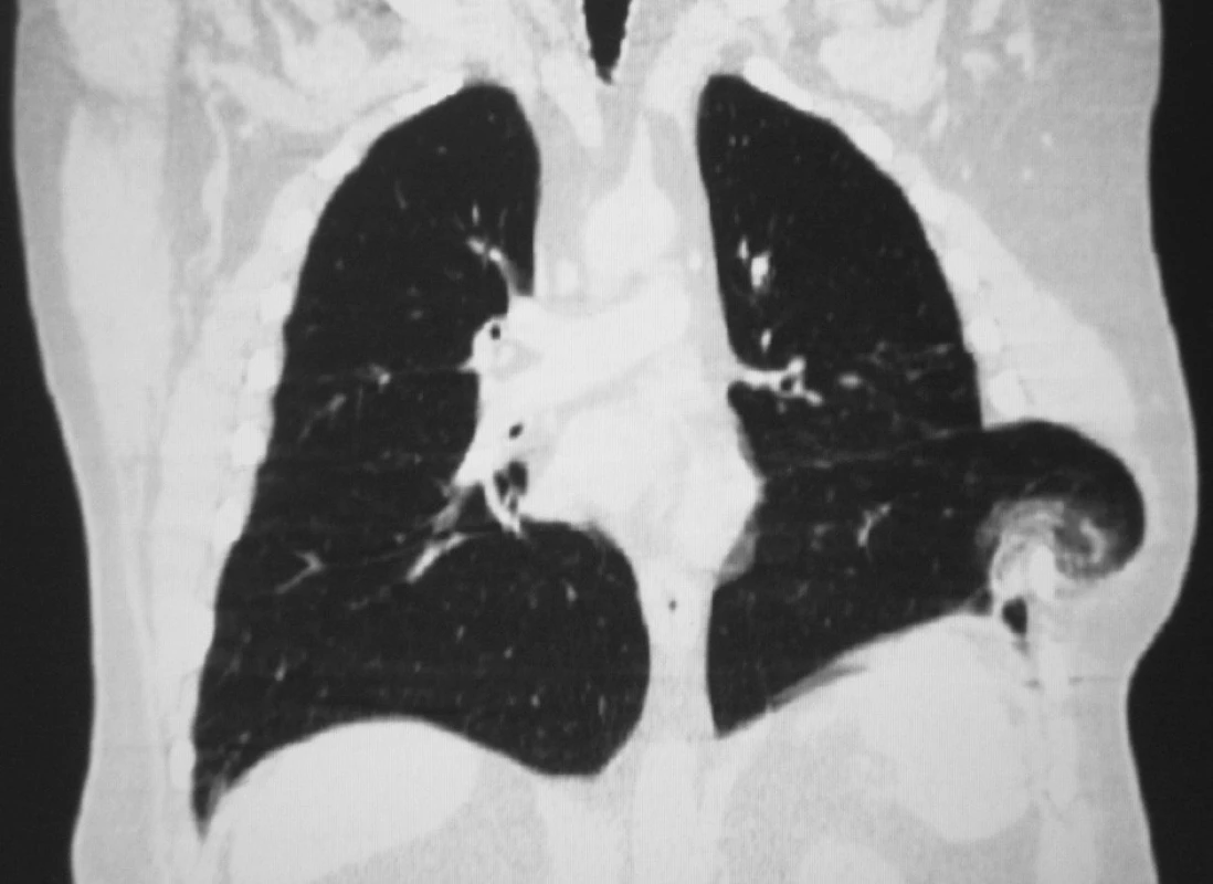 Multiplanárna rekonštrukcia CT – prominencia v VI. medzirebrí vľavo v jazve po limitovanej torakotómii