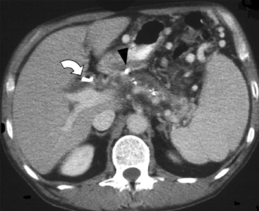 Na postkontrastním CT 2 roky po embolizaci již obě pseudycysty i pseudoaneuryzma zregredovaly. Plastikový drén v hepatocholechu (ohnutá šipka).