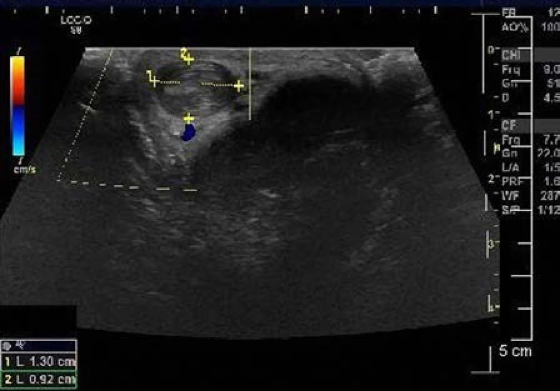 Venózní trombóza v povrchové penilní žíle
Fig. 2 Venous thrombosis of the superficial penile vein