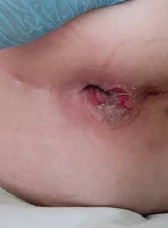 Perianální afekce v důsledku infekce Pseudomonas aeruginosa.