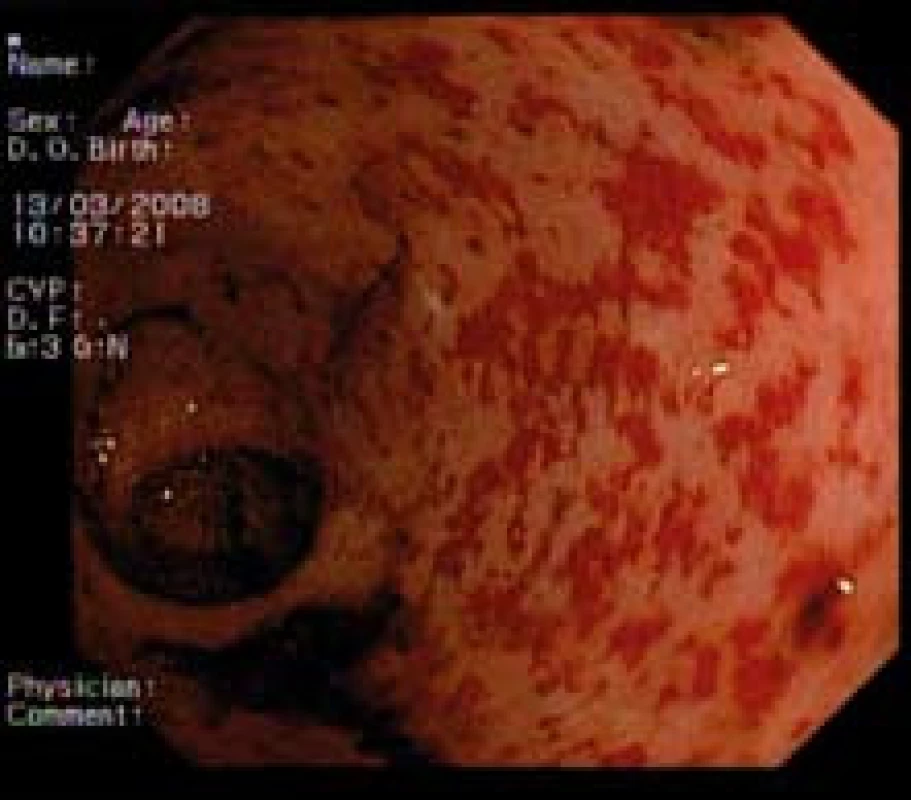 Chronická radiačná proktitída.
Fig. 2. Chronic radiation proctitis.