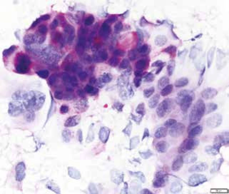 Cytologický nátěr maligních buněk z tenkojehlové aspirační cytologie s průkazem PAS reakce (Periodic Acid Schiff) pozitivních vakuol.