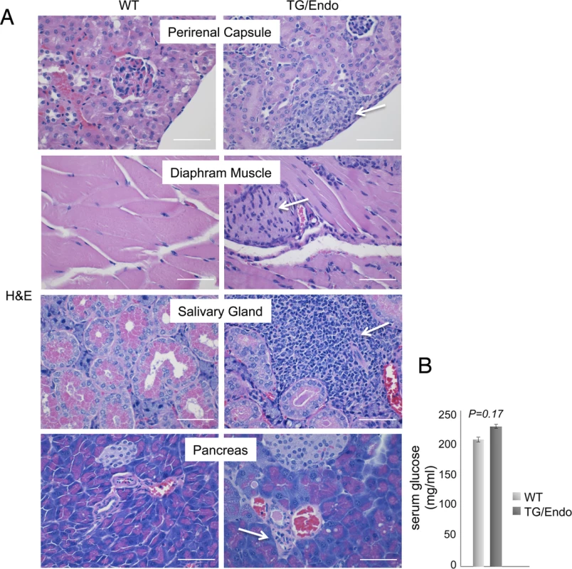 Systemic perineurinal proliferation.