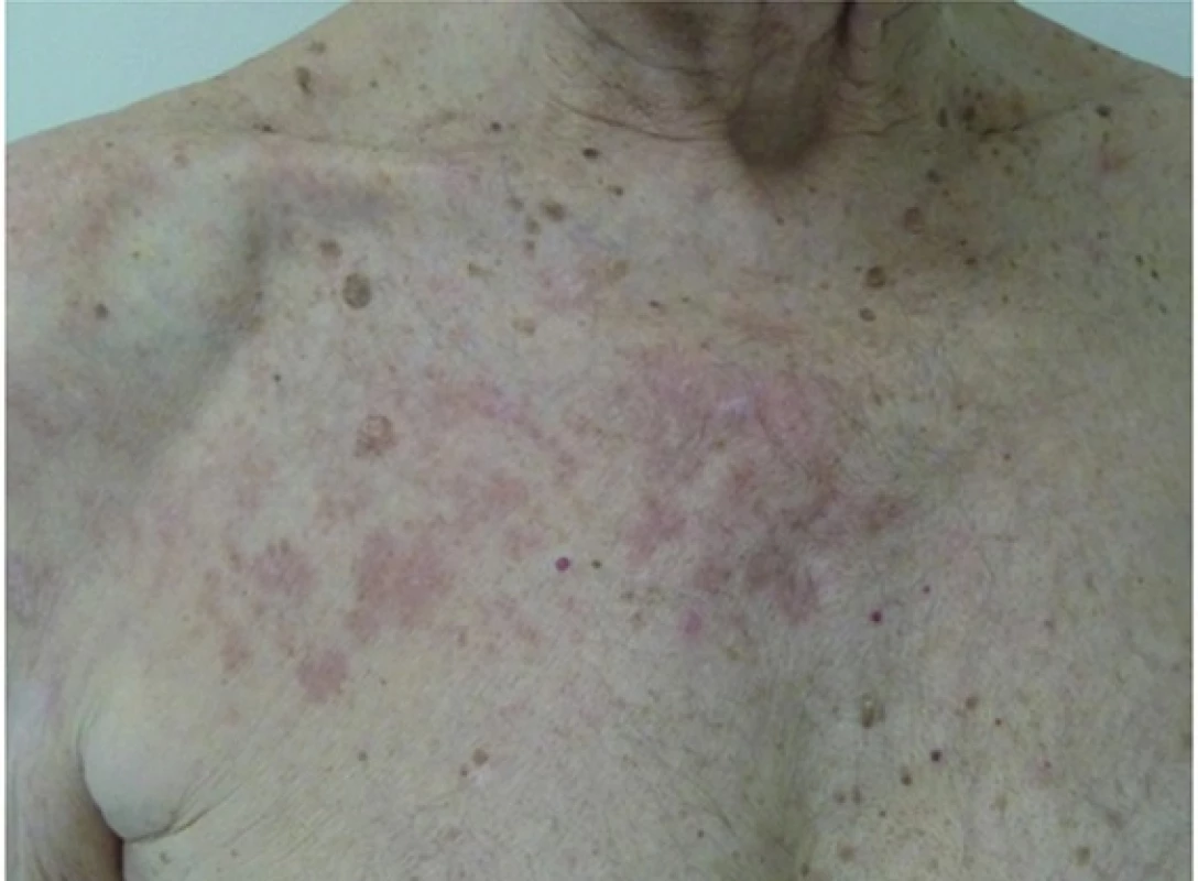 Granuloma anulare v místě předchozího pásového oparu