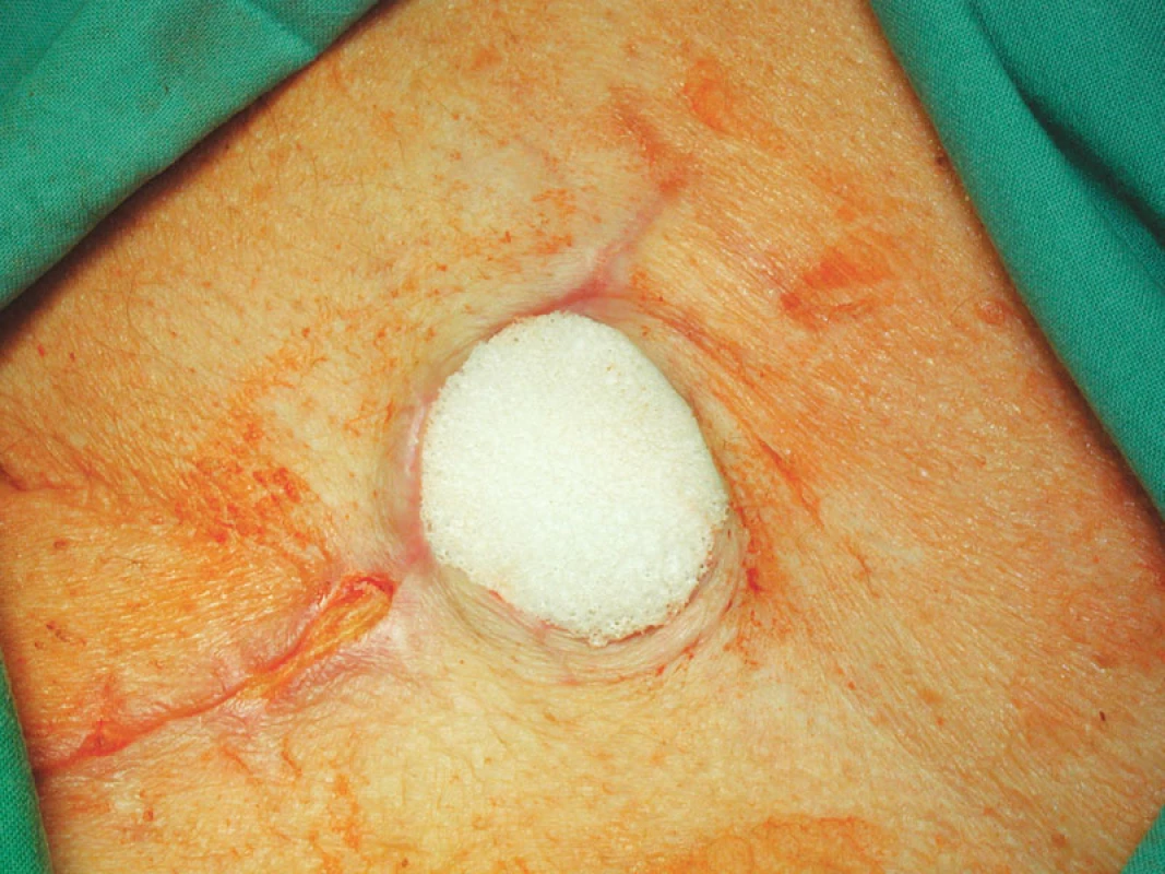 Vyplnění defektu bílou nepřilnavou houbou V.A. C.
Fig. 5. A defect filled up with a non-adherent V.A.C. White- Foam Dressing