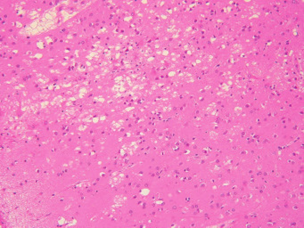 Prominující spongiformní dystrofie s numerickou atrofií neuronů a reaktivní astrogliózou ve frontálním kortexu případu sCJN ve standardním barvení hematoxylinem a eosinem (původní zvětšení 200×).