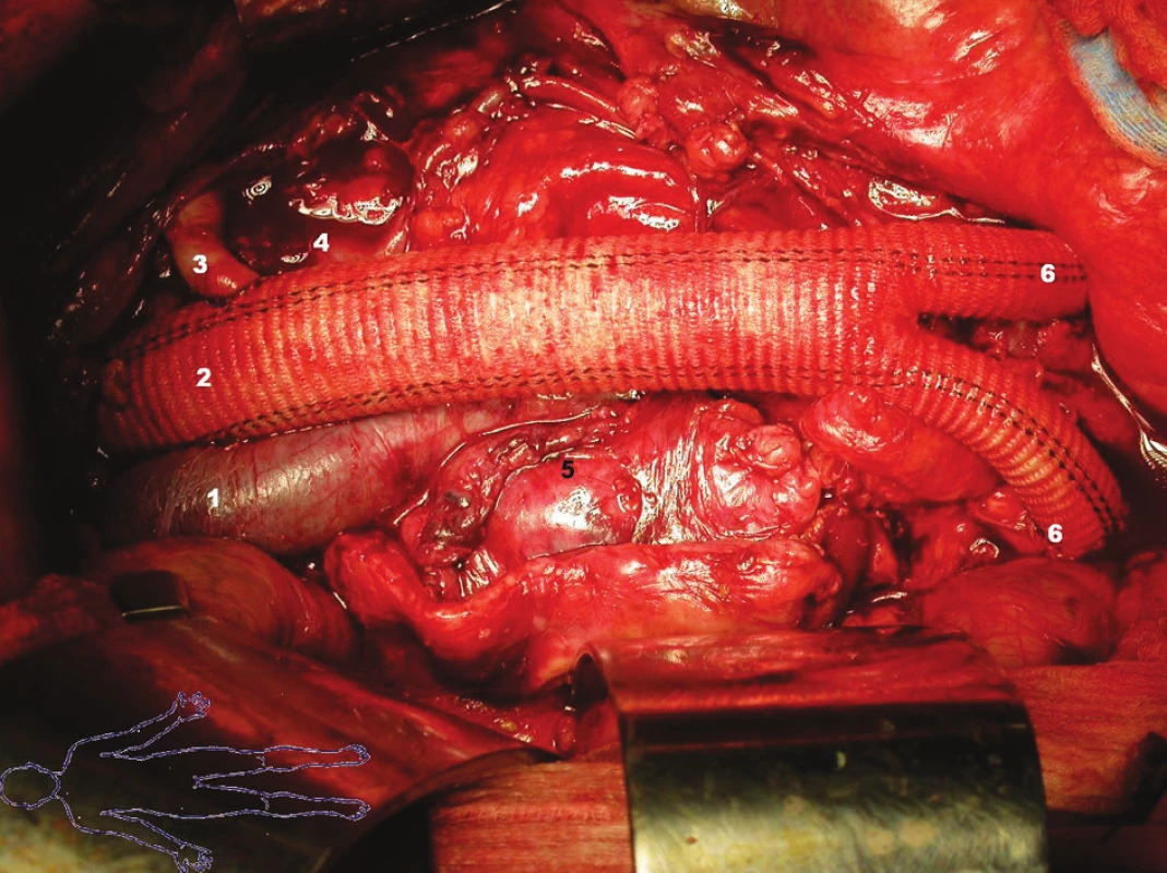 Konečný stav:
1 – vena cava inferior
2 – bifurkační protéza
3 – reimplantovaná arteria renalis sinistra
4 – vena renalis sinistra
5 – prošitý okraj vaku aneuryzmatu
6 – end-to-side anastomóza ramének bifurkační protézy na pánevní tepny
Fig. 4. Final condition:
1 – vena cava inferior
2 – bifurcated prosthesis
3 – reimplanted left renal artery
4 – left renal vein
5 – stitched aneurysmal sac
6 – end-to-side anastomosis of the bifurcation prosthesis branches to pelvic arteries