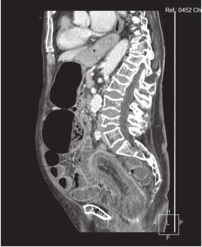 CT obraz invaginace v oblasti colon sigmoidei a obraz ileu, sagitální řez
Fig. 3: CT image of invagination in the sigmoid colon area and ileus, sagittal section