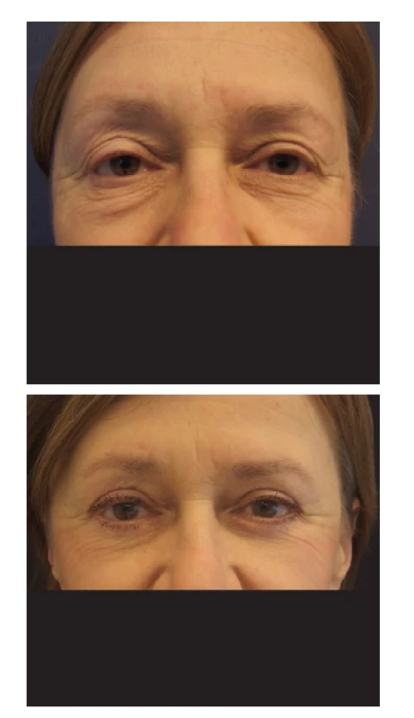 Blefaroplastika u šedesátitříleté ženy
Fig. 2: Blepharoplasty in a 63 years old female
