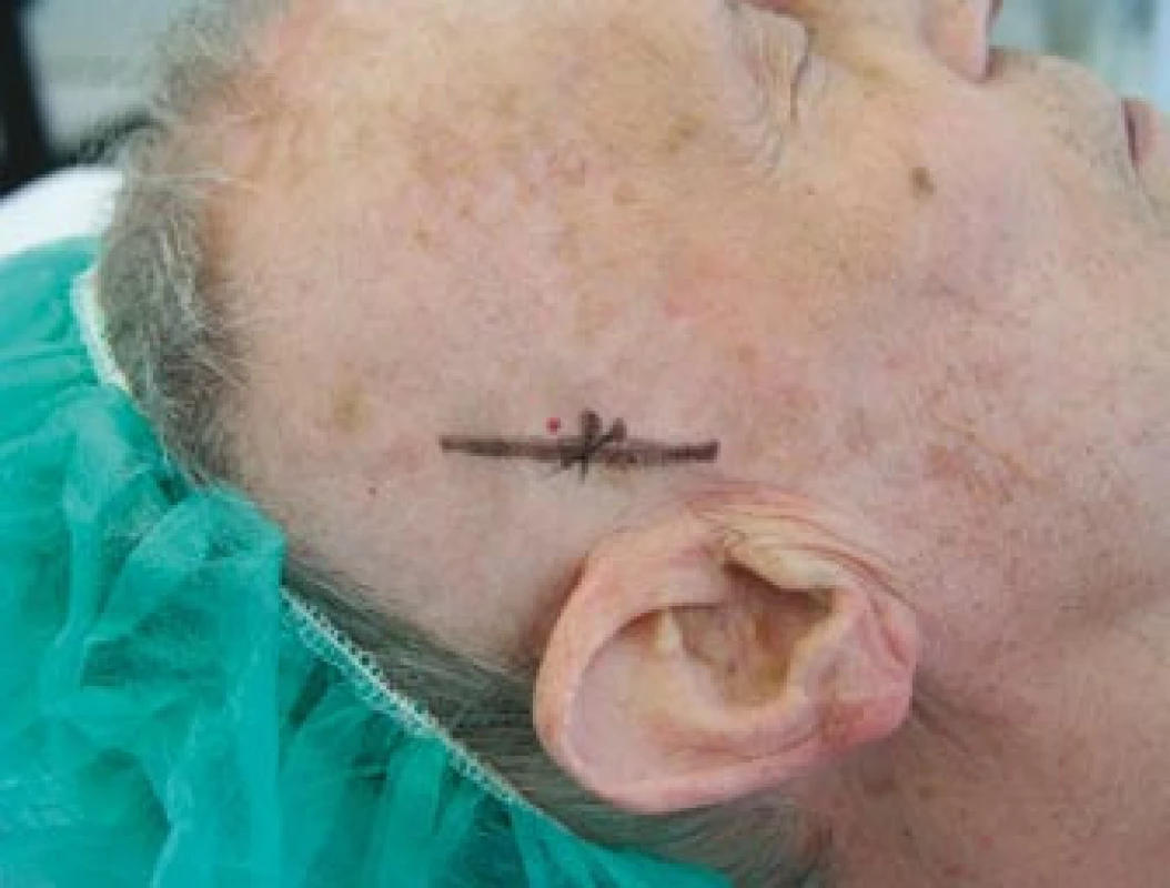 Zakreslený průběh pravostranné větve temporální arterie před její biopsií.