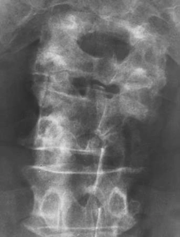 Osteolytický defekt obratlového těla L4 laterálně vpravo velikosti 2 × 1,5 cm