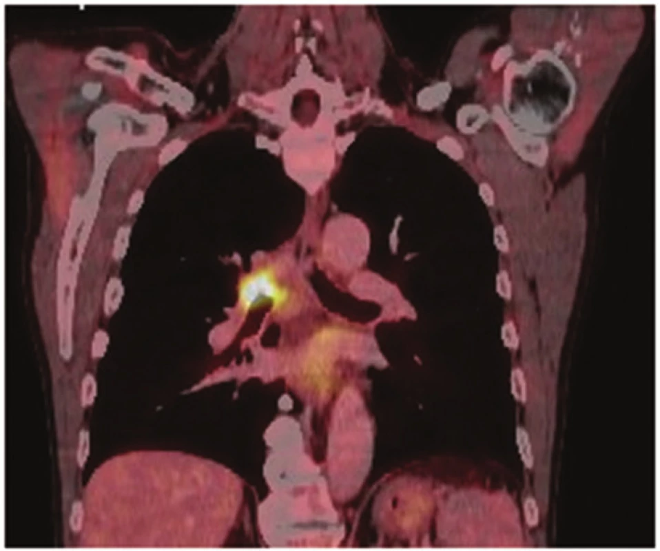 PET/CT: nádorové postižení kariny
Fig. 2: PET/CT: tumor of the carina