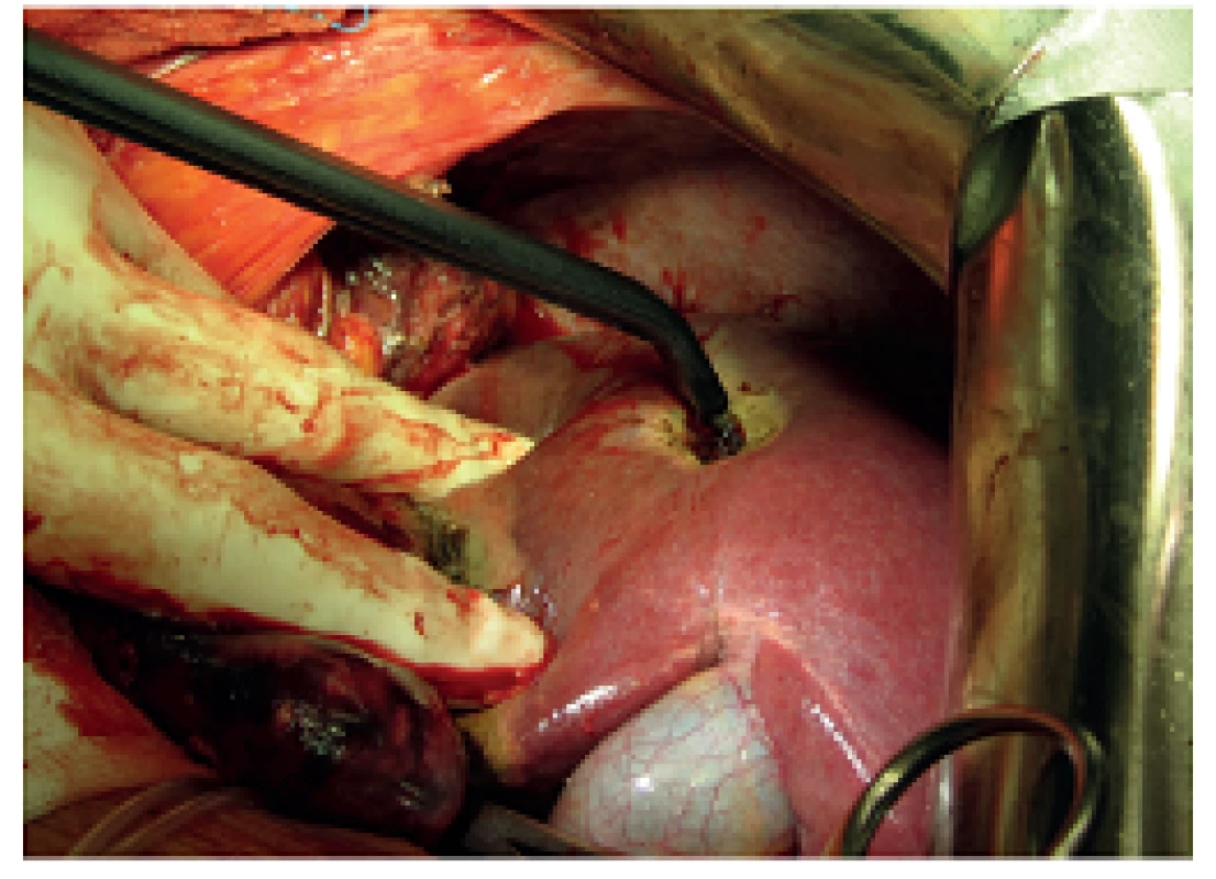 Termální destrukce povrchové metastázy S6 jater
Fig. 5: Thermal destruction of the surface liver metastasis at S6