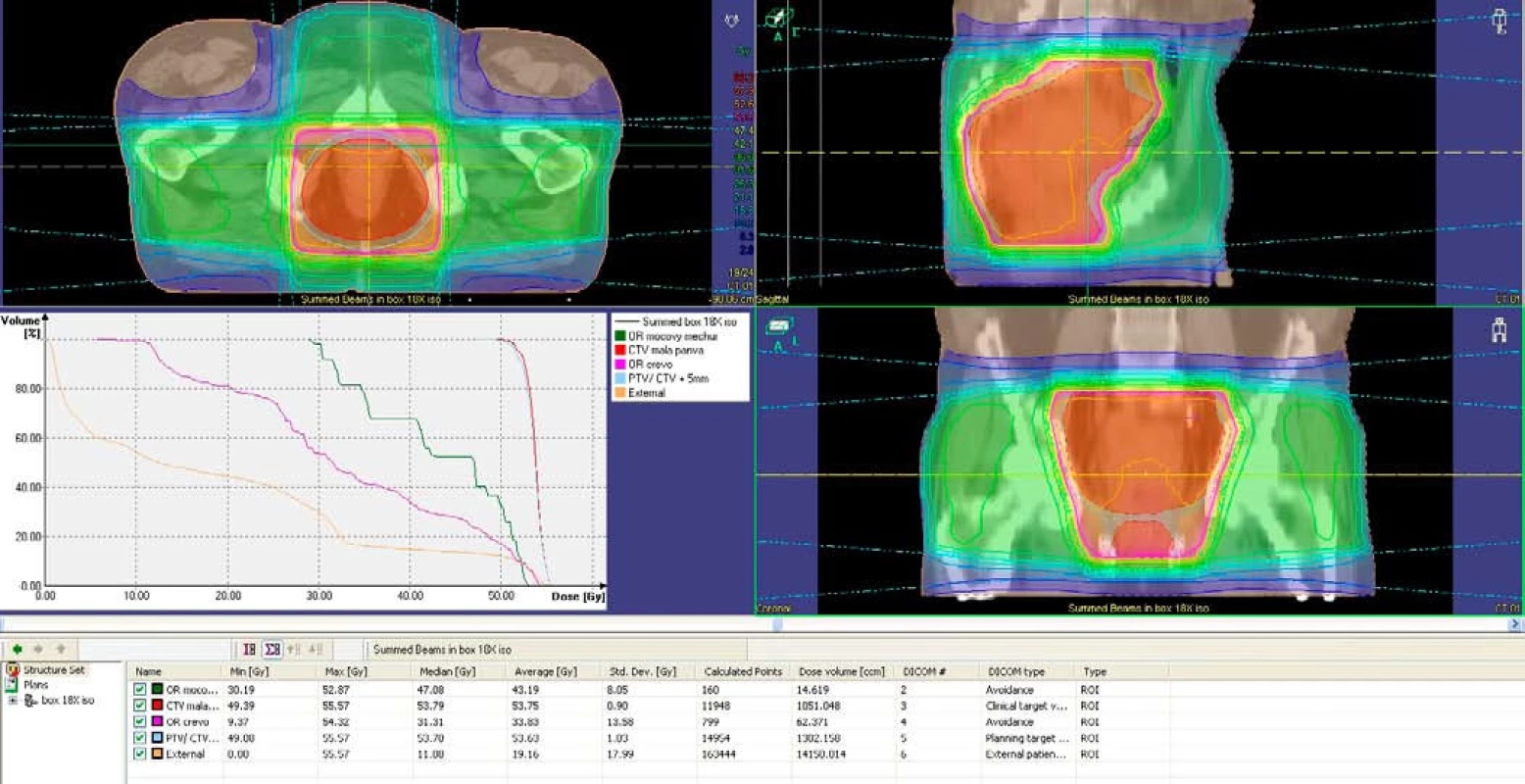 Plánovací objem v axiálnej, sagitálnej a koronálnej rovine, dávkovo-objemový histogram.
Fig. 1. Planning volume in axial, sagital and coronal plane, dose-volume histogram.