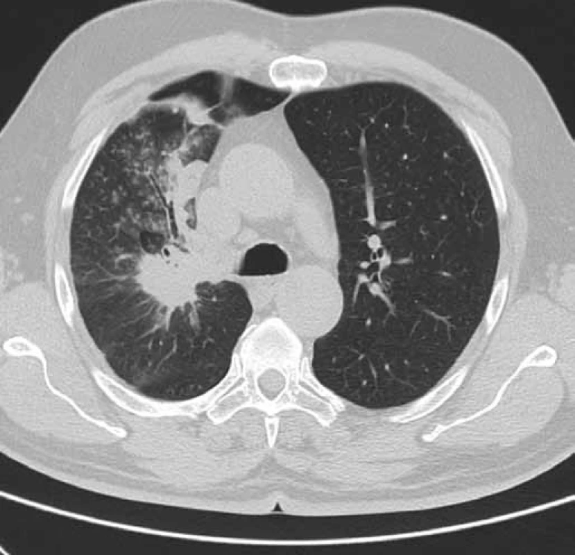 CT hrudníku pacienta č. 1 v době zahájení léčby erlotinibem (únor 2011).
Obrázek zobrazuje tumor horního laloku pravé plíce a související dys-/atelektatické změny v oblasti horního laloku pravé plíce.