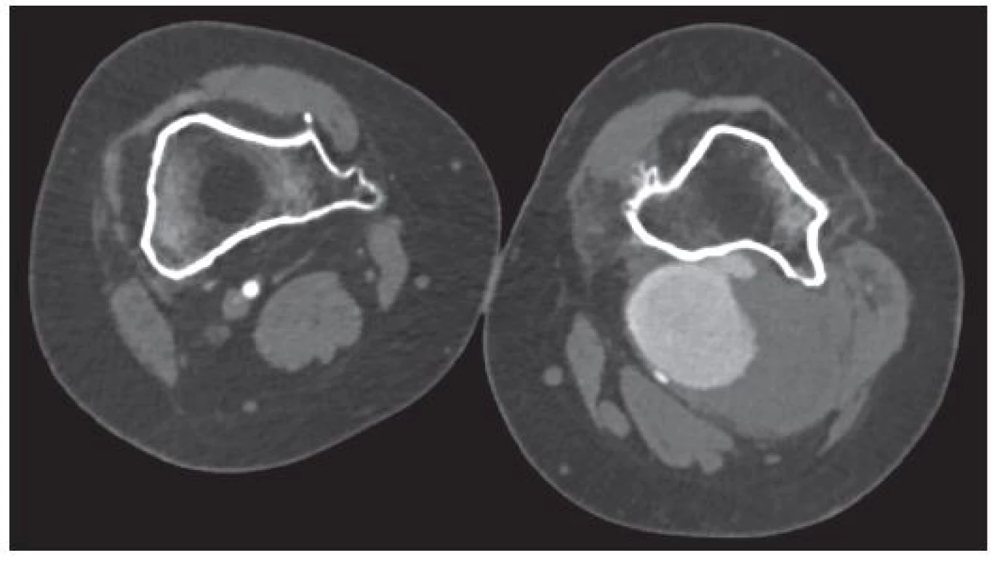 CT angiografie, axiální snímky
Fig. 1: CT angiography, axial images