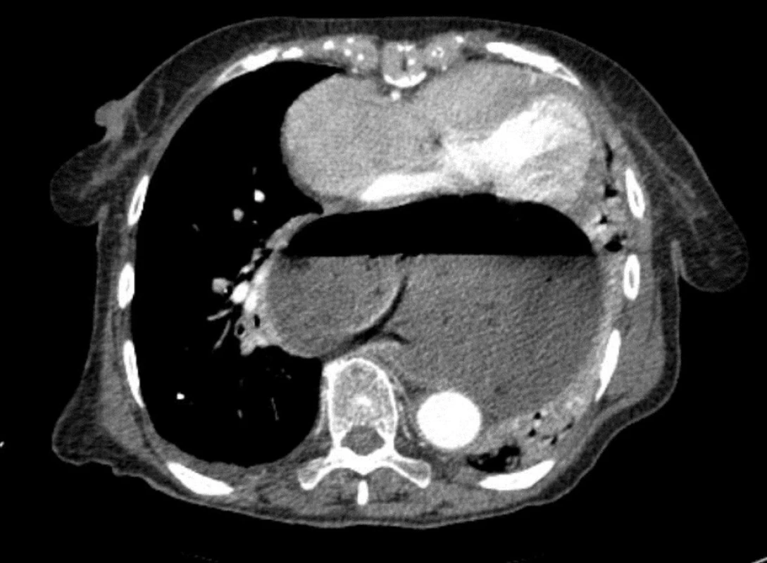 Axiální snímek CT
Fig. 9: Axial CT image