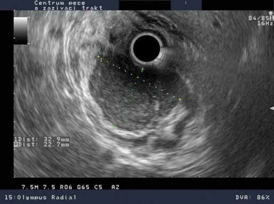 EUS nález – hypoechogennní léze 33 × 23 mm vycházející ze 2. echovrstvy – muscularis mucosae.
Fig. 2. EUS findings – hypoechoic lesion 33 ×23 mm originating from the 2<sup>nd</sup> echolayer – muscularis mucosae.