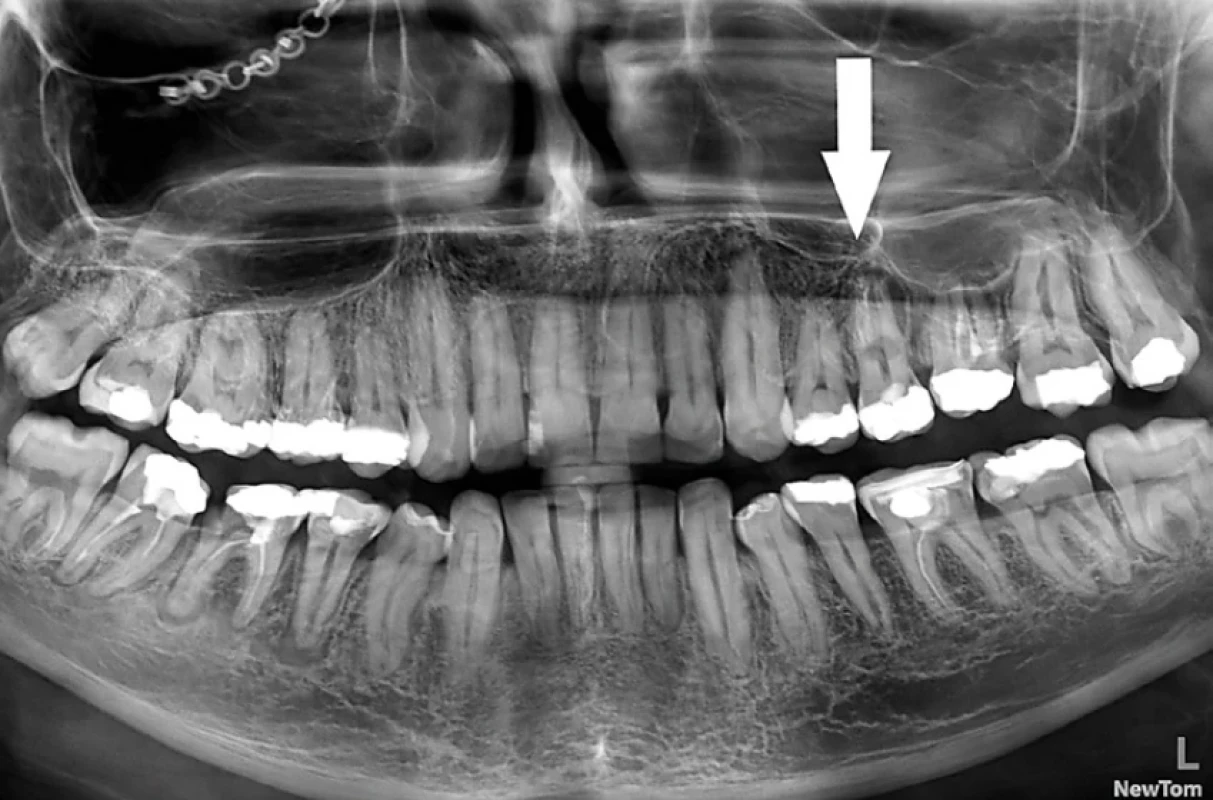 Interná zápalová resorpcia koreňa zuba 25 – diagnostikovaná šesť rokov po traume. Zdroj: Simona Fritzká. Fig. 2 Internal root resorption of tooth 25 – found six years after trauma. Source: Simona Fritzká.