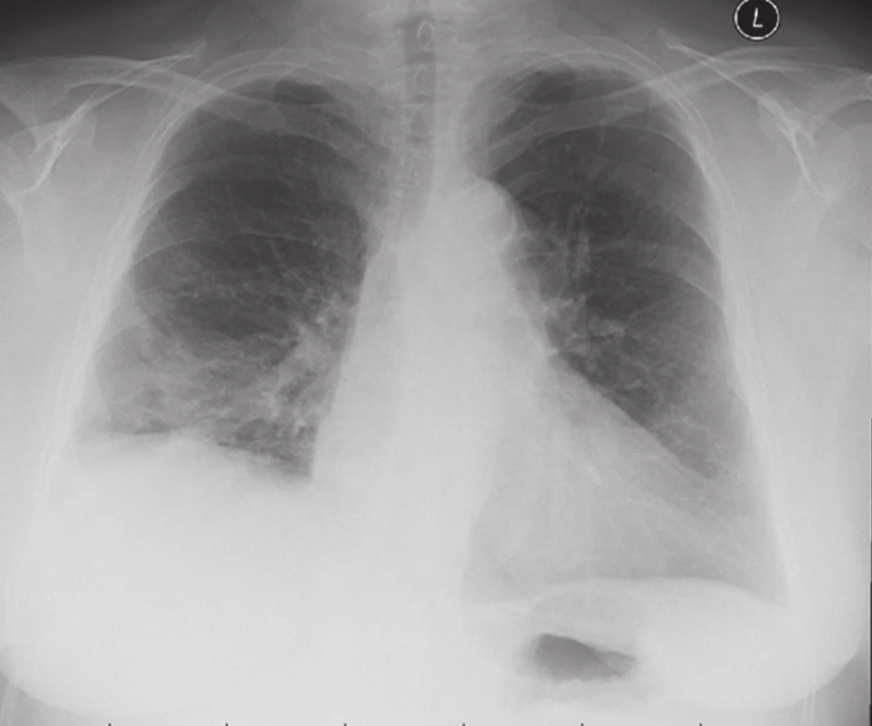 RTG po retransplantaci
Fig. 2. Chest X-ray after re-transplantation